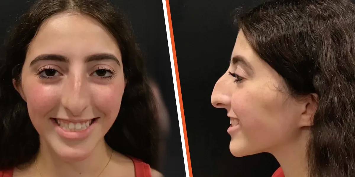 This Girl Stunned Everyone with Her Rhinoplasty Results – 7 More Rhinoplasty Transformations Everyone’s Talking About