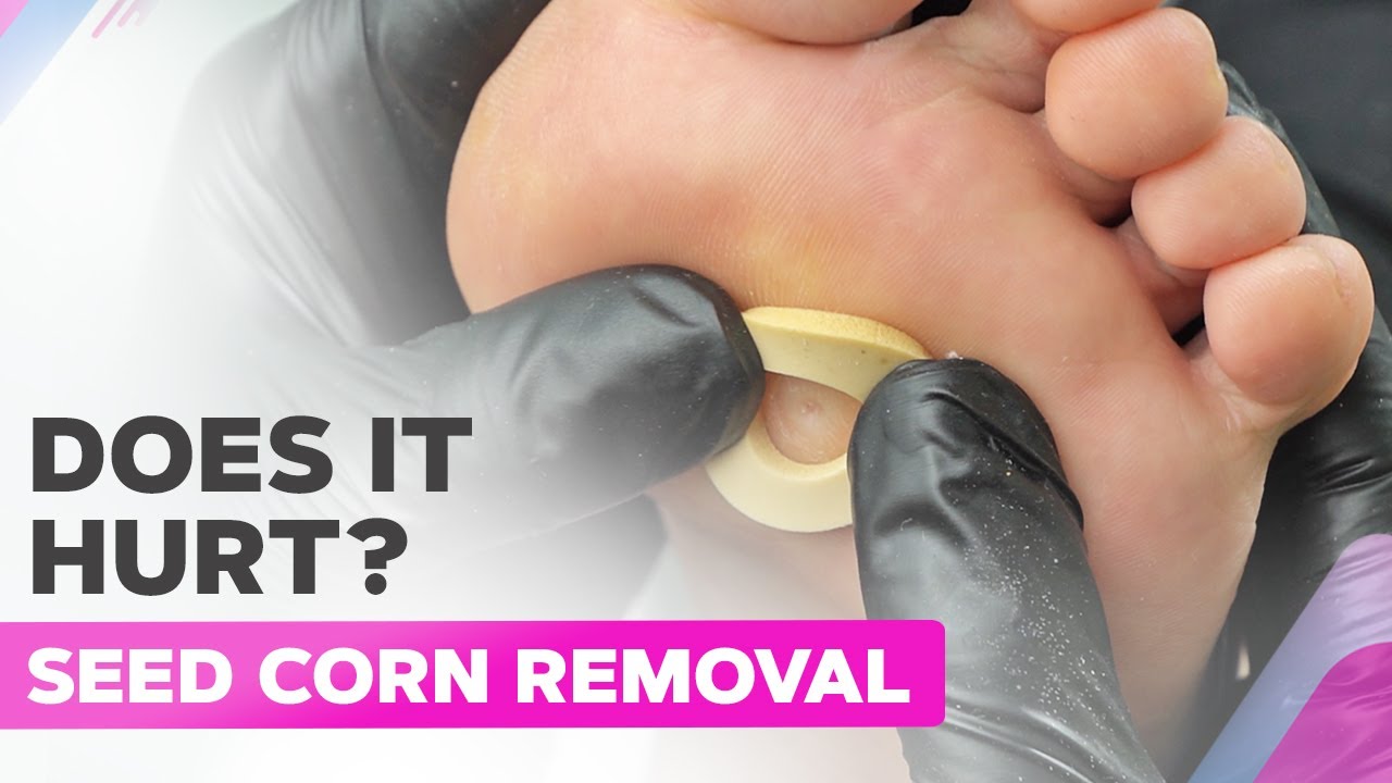 How To Remove a Seed Corn? Step-By-Step Guide